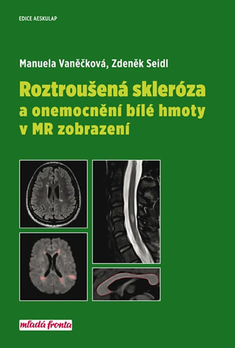 Obrázok Roztroušená skleróza a onemocnění bílé hmoty v MR zobrazení